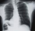 the image to "lung cancer" in Polish